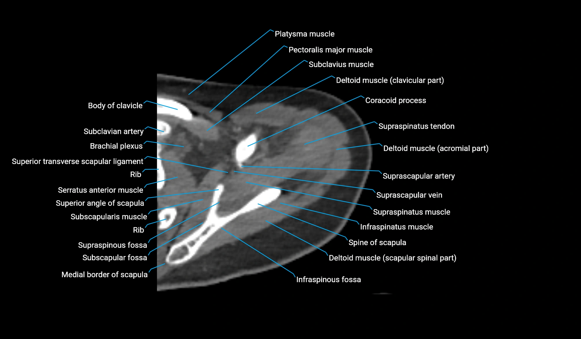 CT upper arm axial  cross sectional anatomy labelled radiology image -00074.webp